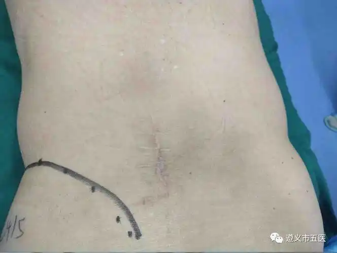 两次开刀——遵义市五医神经脊柱外科成功解除患者多年腰腿疼痛_手术