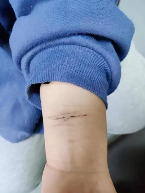 出现自残行为是几度抑郁(广东17岁抑郁女孩用剪刀自残) - 看百科