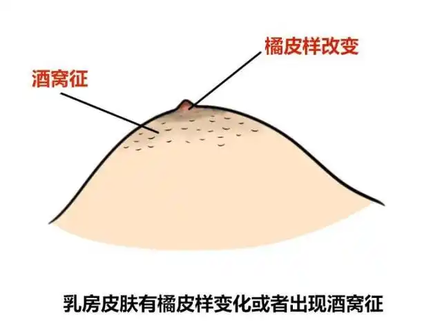 3 症状三:乳房皮肤有橘皮样变化或者出现酒窝征.