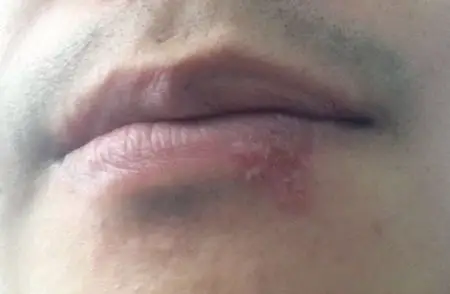 问:下嘴唇起泡,请问是怎么回事,如何治疗啊?