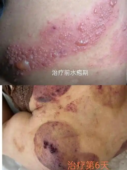 有一种剧痛叫"带状疱疹"!得了怎么办?看看这里