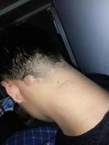 帮我看一下我后脑勺左边这个大包是怎么回事,治了一个多月了,挂点滴就