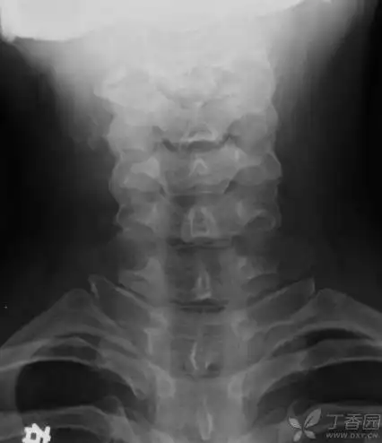 70岁.很典型的颈肋.