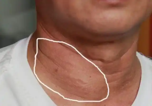 甲状腺肿起了一个包,怎么办?