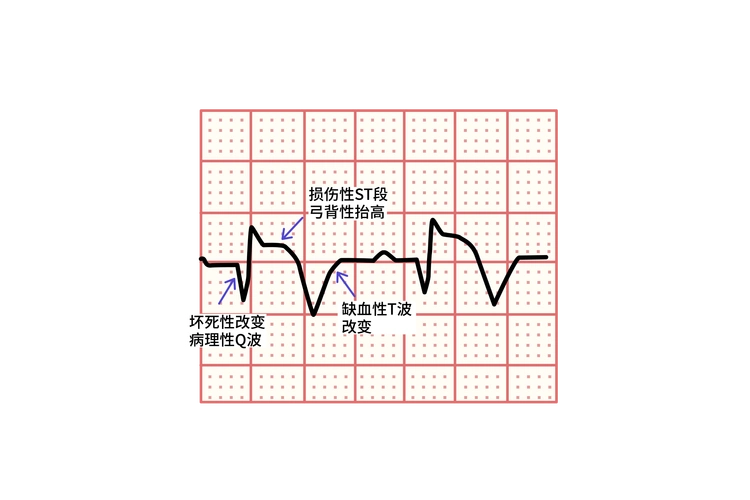 心肌梗死心电图图片