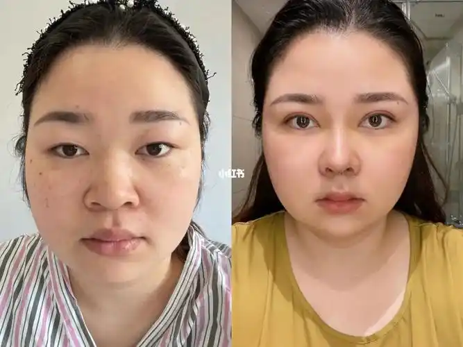 眼鼻综合术后11天|今天放个对比图_鼻综合_杭州攻略_全切双眼皮_变美