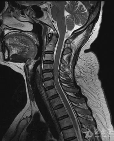 原创:颈椎病各种表现情况 图文介绍