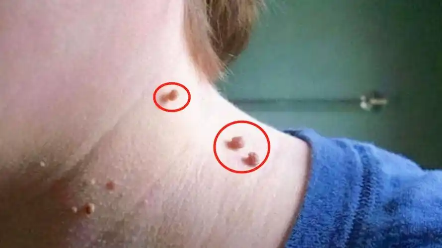 脖子上的小肉粒说明身体出了问题一定要引起重视