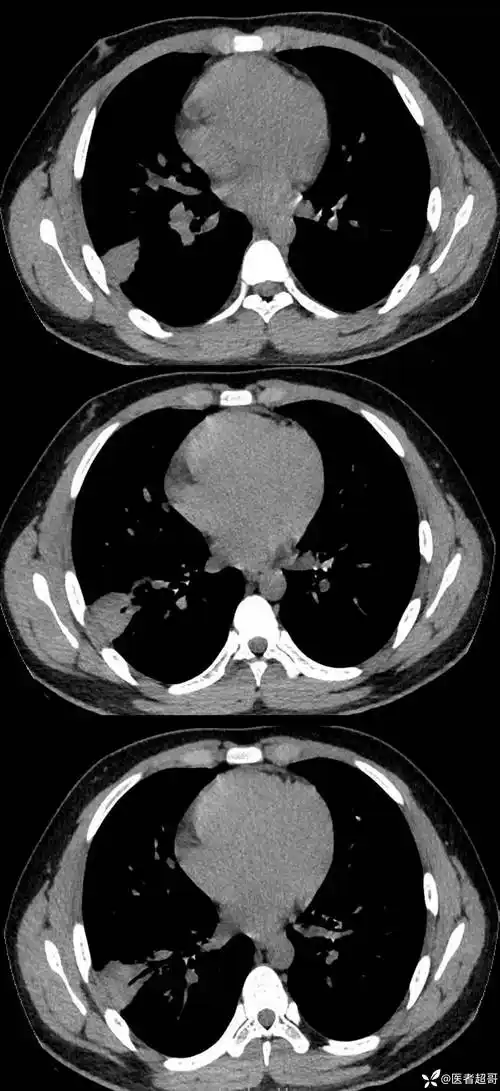 双肺下叶高密度伴充气支气管征象请分析