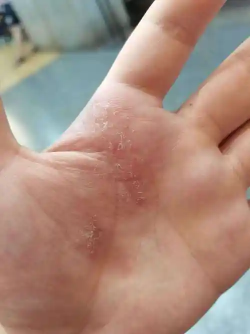 【医生回答】根据你的描述和照片情况,考虑是汗疱疹的表现,多见于手掌