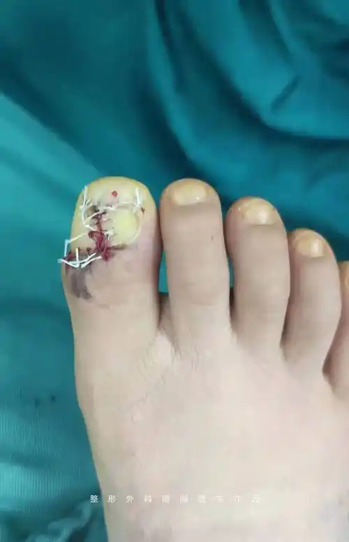 儿童指甲下黑线-甲母痣的治疗_痣_痣症状表现 - 好大夫在线