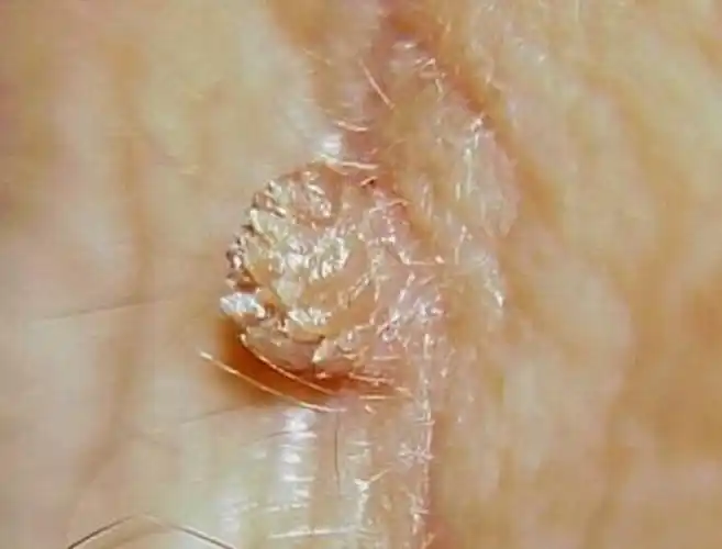 丝状疣的对比图片