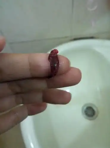 流出来的孕囊是怎样的(有图慎入)