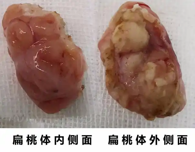 儿童扁桃体切除术怎么做术后不痛_扁桃体炎_扁桃体炎治疗方式 - 好