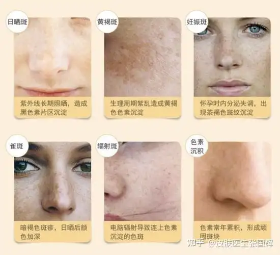 雀斑和黄褐斑的区别? - 知乎