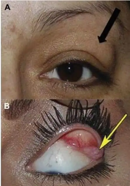 你以为只是肿泡眼当心还有泪腺脱垂