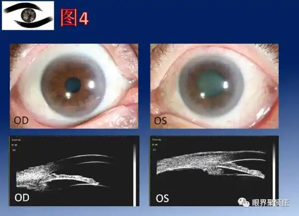 眼睛青光眼症状图片,看图识病九宫格系列青光眼