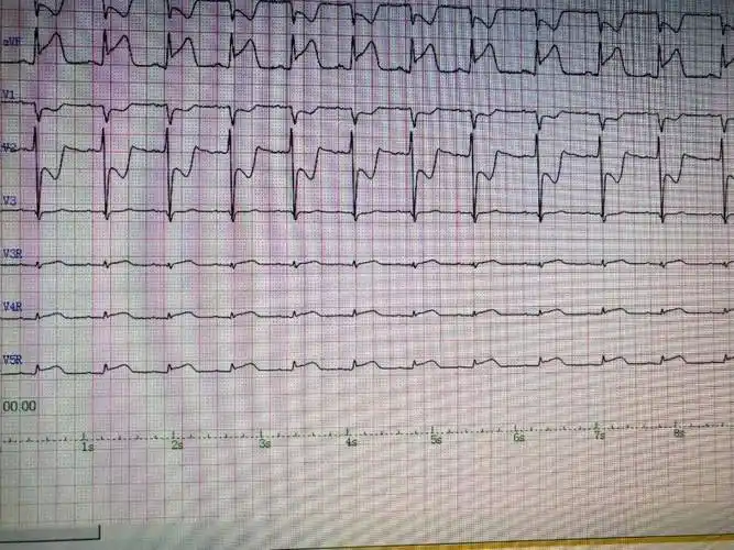 溶栓前心电图21:27,首份心电图报告确诊陈先生为窦性心动过缓,急性下