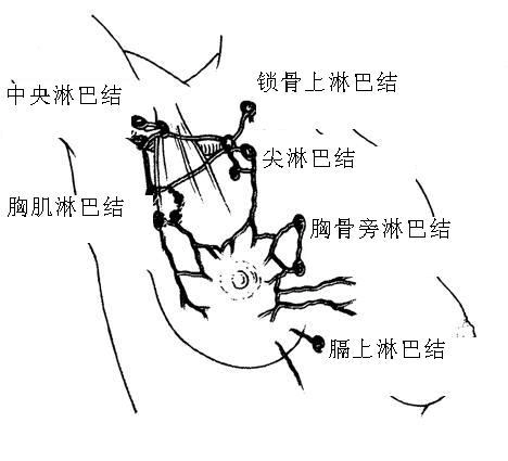 临床意义:乳腺癌发生淋巴转移时,可侵犯腋淋巴结和胸骨旁淋巴结