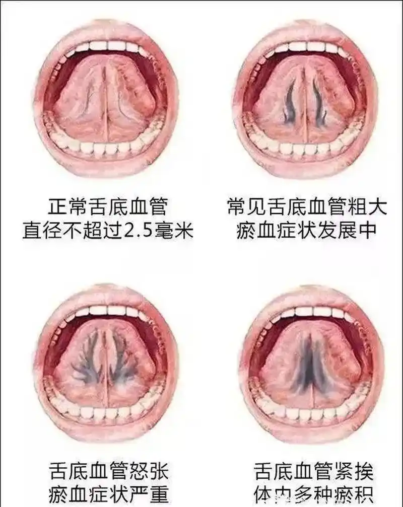 中医舌下脉络的秘密