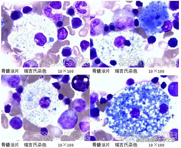 老师们的讨论病例二:海蓝组织细胞增生症现病史患者苏xx,女,26岁.
