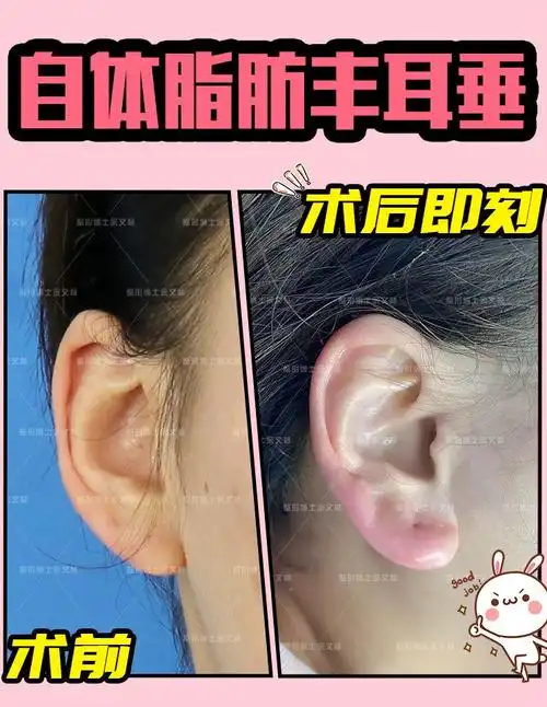 一招可以让耳垂饱满看着有福气_耳部整形_耳部整形治疗介绍 - 好大夫