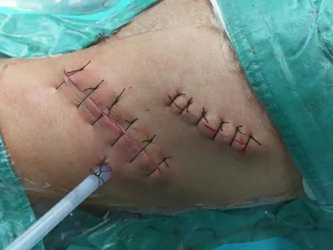 南华大学附属第一医院脊柱外科---腰前微创切口下矫正脊柱侧凸