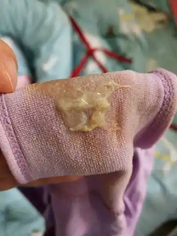 生完孩子后白带味道很重,一天换一次内裤都是一样.