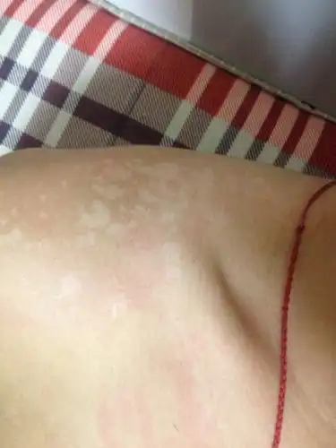 问:汗斑怎么治 需要注意什么