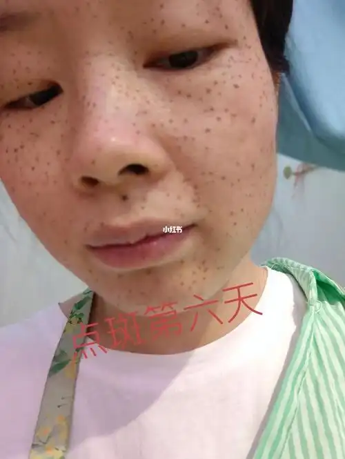 药水点斑第六天