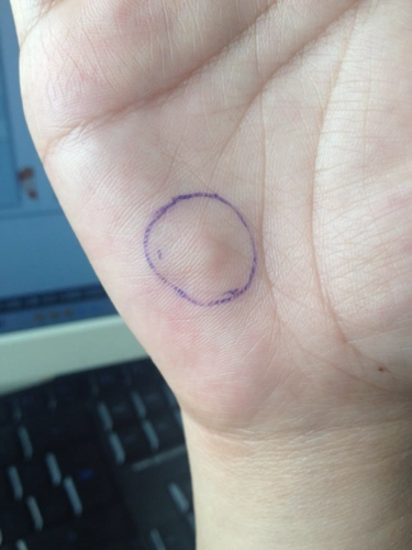 距离预产期还有19天 手掌里长了一个硬疙瘩不痛不痒 请问有没有知道这