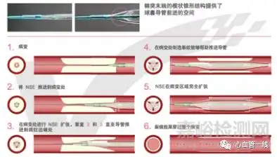 棘突切割双导丝球囊使用细节和药物球囊dcb的优势
