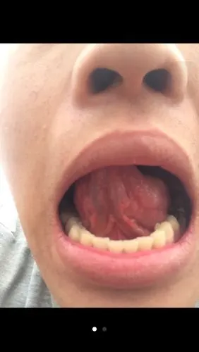 舌头下长了两段三厘米小肉条没感觉 肉条是对称的