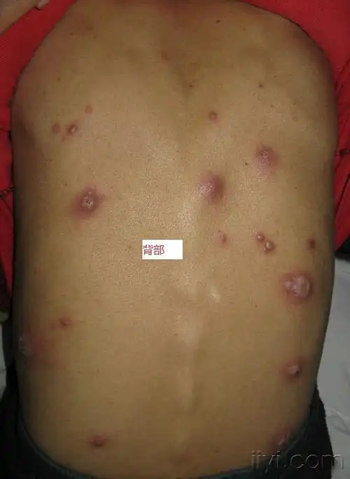 38:08   男 31岁 ,2月半前 左下颏起丘疹,自行挤捏,局部出现糜烂,溃疡