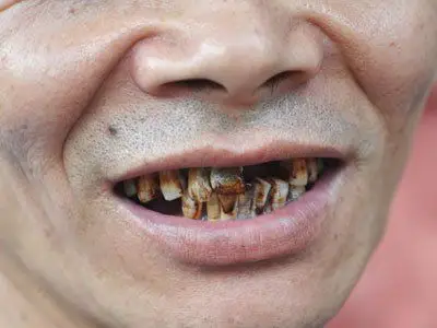 连续吃5年槟榔,身体会发生什么变化?湖南小伙被割了半张脸