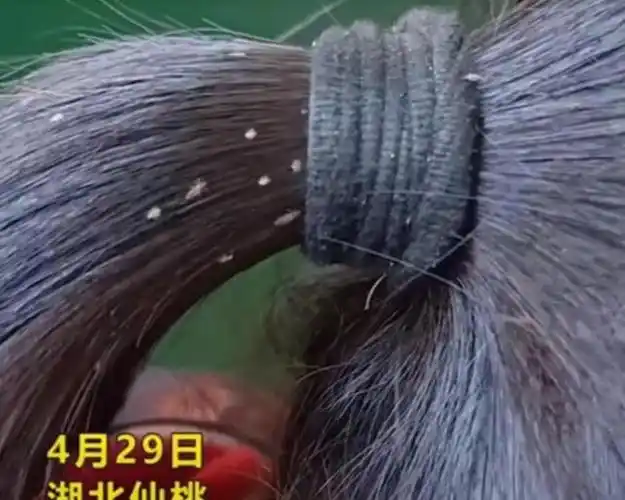 湖北女孩虱子满头爬,只因父母在外务工不在家,可怜又可悲