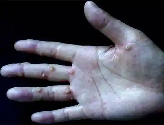 有了这个技术之后,皮肤五大疾「痣疣瘤斑藓」就很容易被攻克了!-母婴