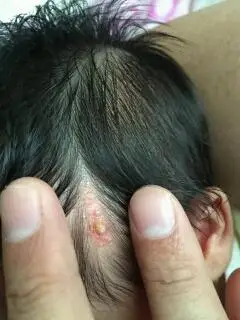 宝宝头上有块跟癣是的东西,上边还起了包包,哪位知道这是什麼吗?