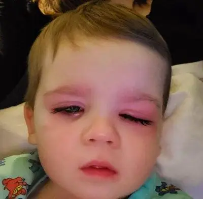 后来却发现儿子的眼睛似乎更红了点,便赶紧去找医生.