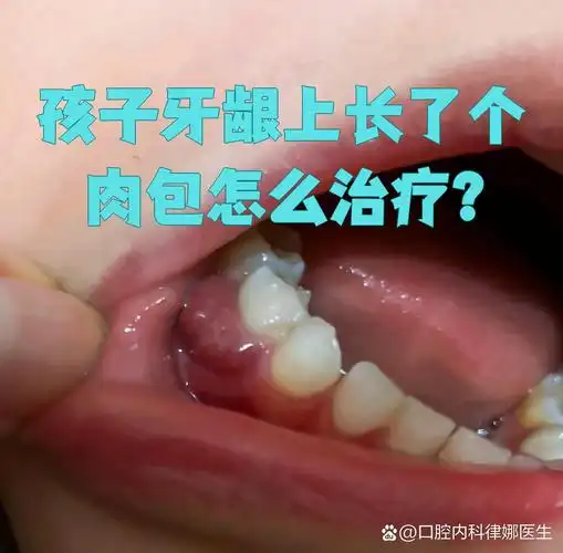孩子牙龈上长了个肉包,最常见的原因是慢性根尖周炎或牙龈囊肿