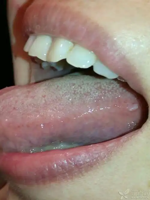 老师说考虑乳头状瘤,让回去观察一周 可为啥我觉得只是个炎症呢?