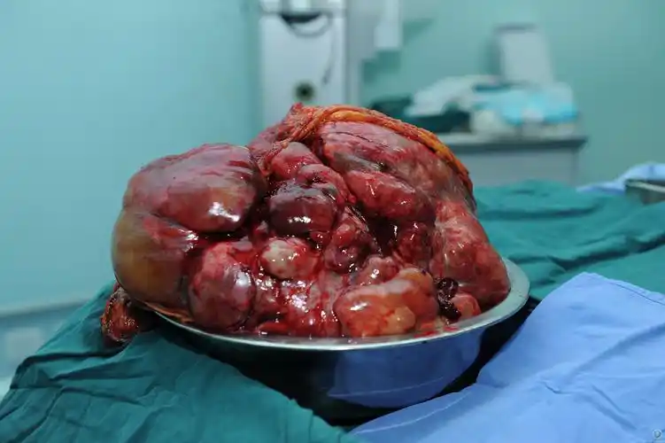 重庆市肿瘤医院胃肠外科完成一例腹腔巨大恶性肿瘤切除术