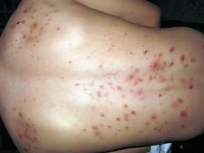 背上长痤疮可能是马拉色菌感染毛囊炎治疗需要注意