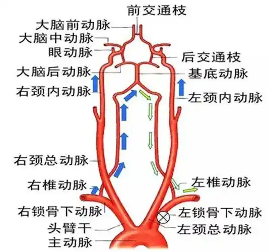 典型病例丨龙海一男子被头晕怪病困扰2年,罪魁祸首在脑血管造影术下现
