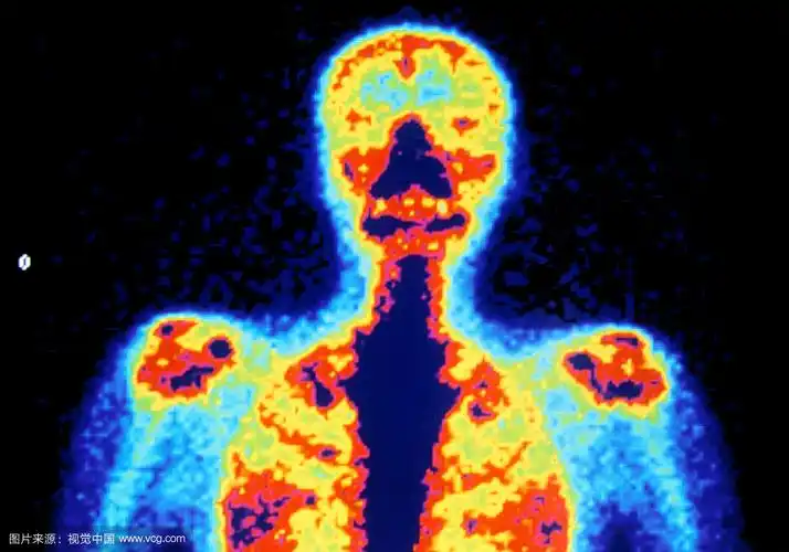 放射性核素扫描