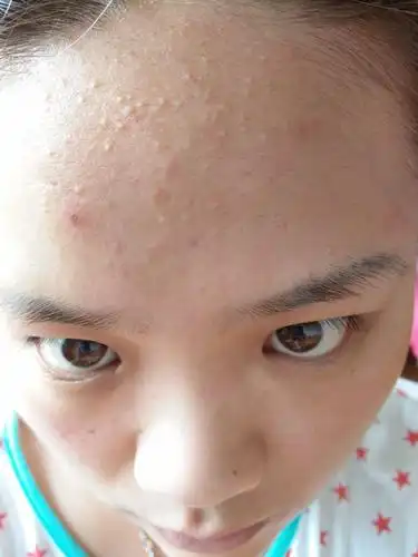 哪里治疗粉刺,不复发