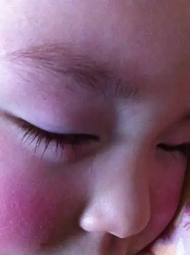 小儿眼科 疾病: 我儿子4岁,右眼下眼皮长个霰粒肿