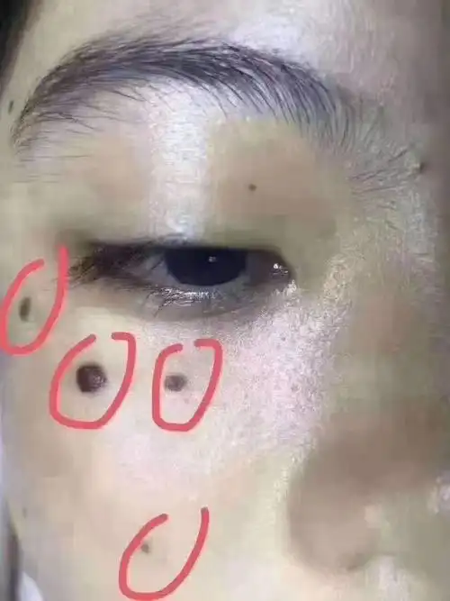 眼睛下方的痣又称为泪痣哭痣99997715相书上云:一生流_圈子