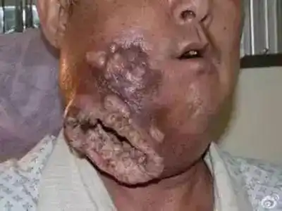 槟榔危害:槟榔制作:央视报道:"槟榔"已经被世卫组织列为一级致癌物!