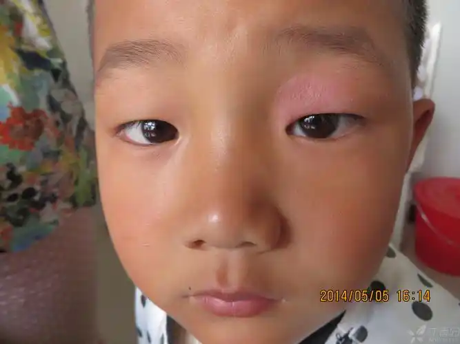 【请教】单侧上眼睑皮疹诊断湿疹正确吗